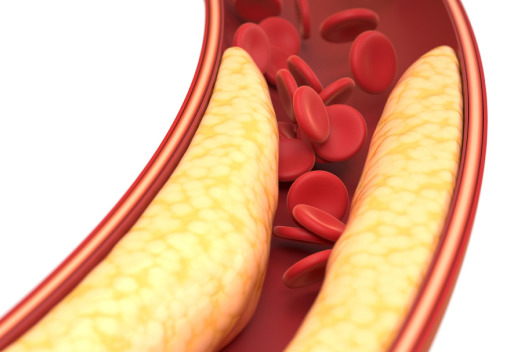High Cholesterol